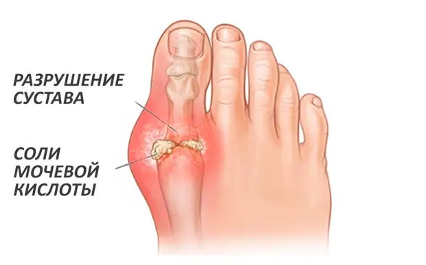 Соли в организме и связанные с ними заболевания
