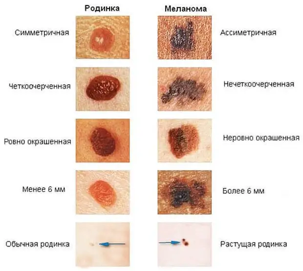 Проверьте свои родинки