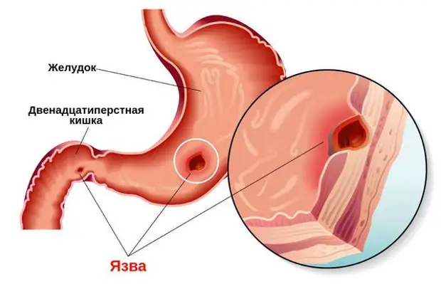 Язвенная болезнь желудка