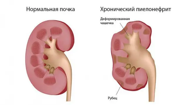 Признаки урологических заболеваний