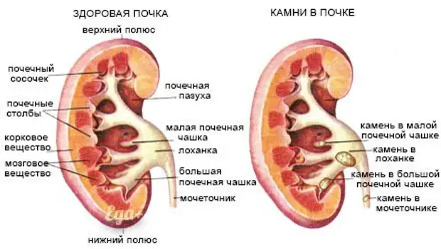 Основные причины цистита и урологических проблем, о которых вы могли не знать