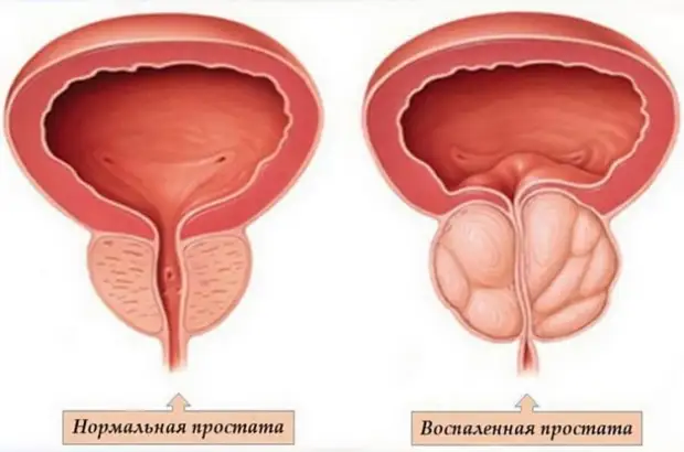 Признаки урологических заболеваний