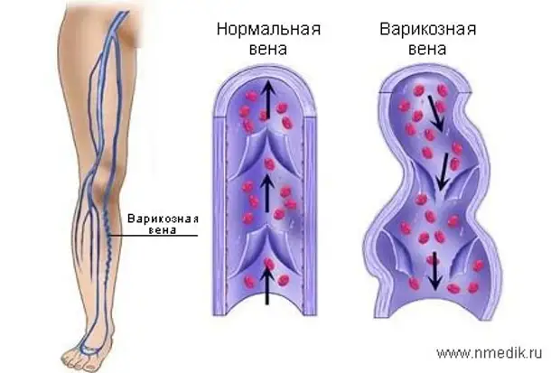 Как распознать варикоз и остановить болезнь на ранней стадии
