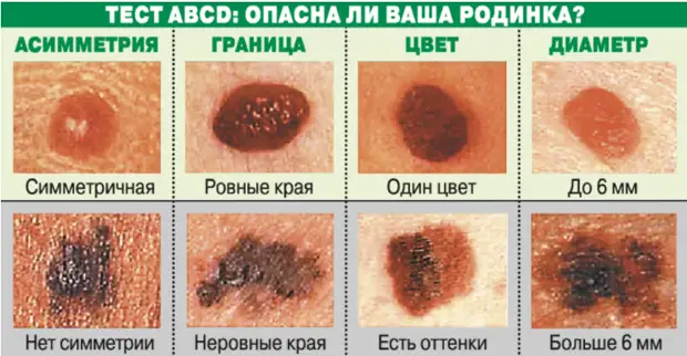 Почему многим нельзя загорать и какие родинки опасны
