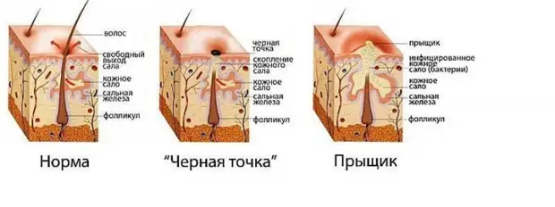 Почему появляются прыщи