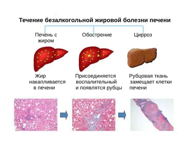 17 вредных свойств сахара, разрушающих здоровье человека