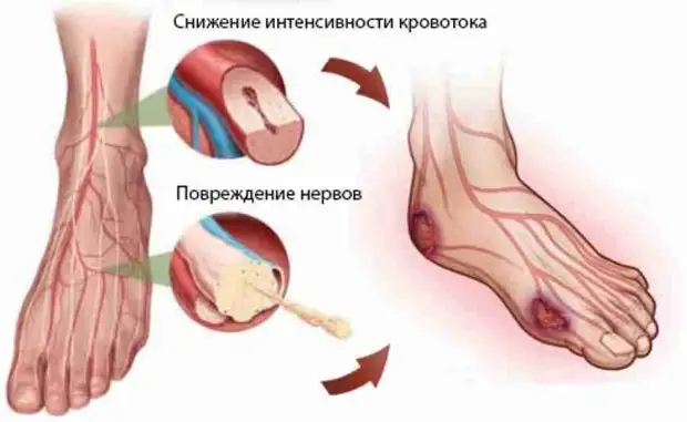 Как развивается диабетическая стопа