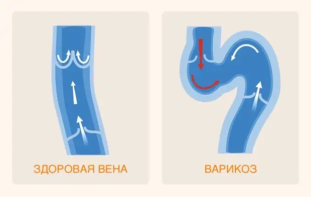 Здоровая вена и варикоз