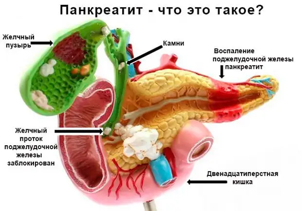 Что такое острый панкреатит