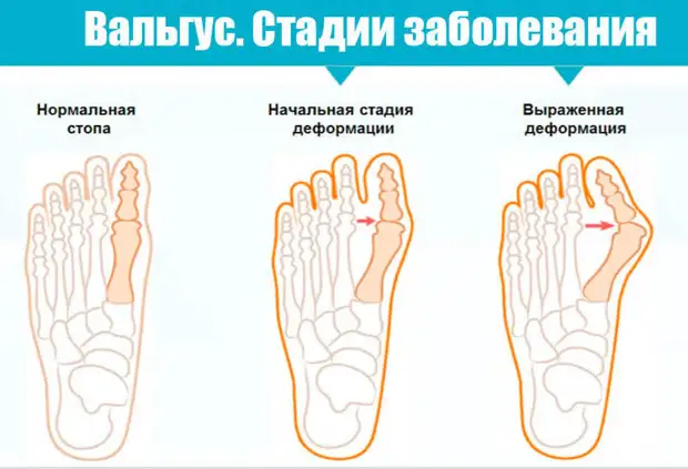Почему происходит вальгусная деформация стопы