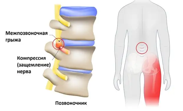 Как вылечить в домашних условиях защемление седалищного нерва