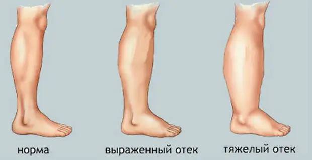 Почему отекают ноги
