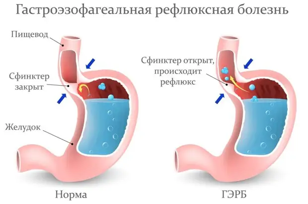 Причины изжоги