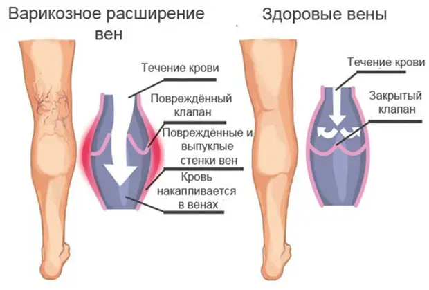 Полезные и вредные упражнения при варикозе