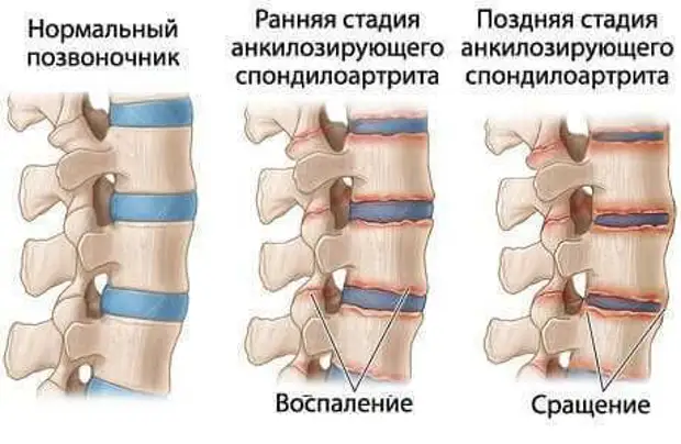 Что может спровоцировать развитие болезни Бехтерева
