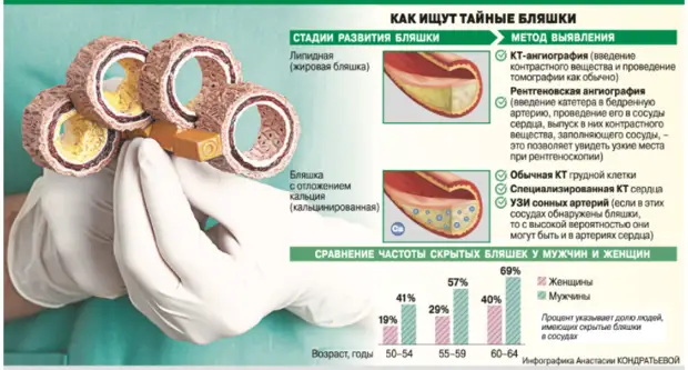 Чем опасны скрытые бляшки в сосудах