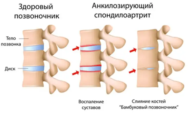 Что может спровоцировать развитие болезни Бехтерева