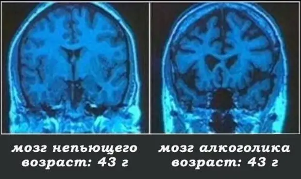 Шокирующая правда об алкоголе