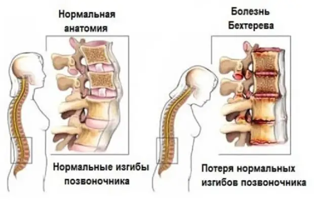 Что может спровоцировать развитие болезни Бехтерева