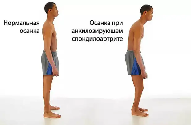 Что может спровоцировать развитие болезни Бехтерева