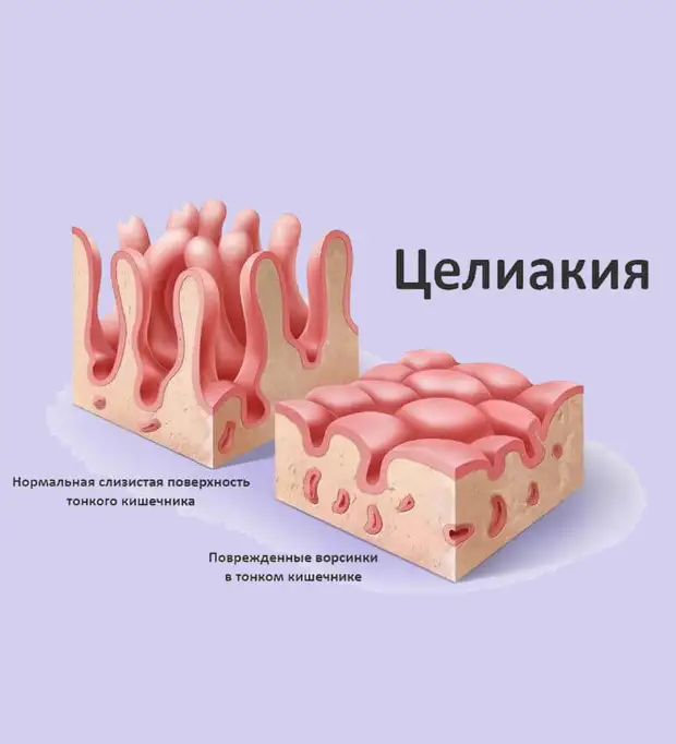 Что такое Целиакия
