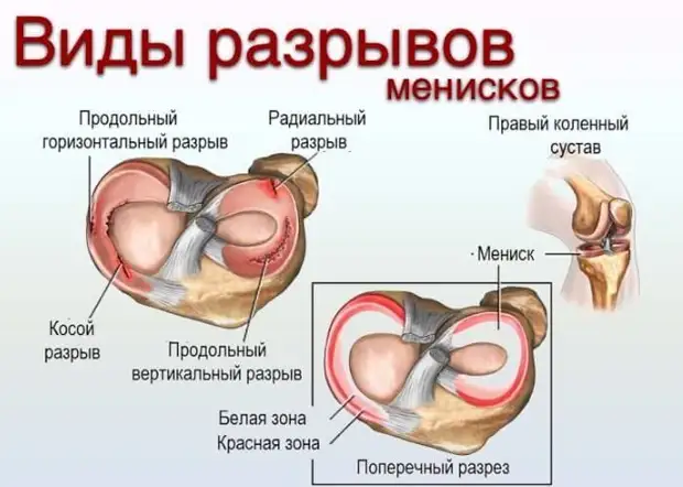 Упражнения для коленного мениска