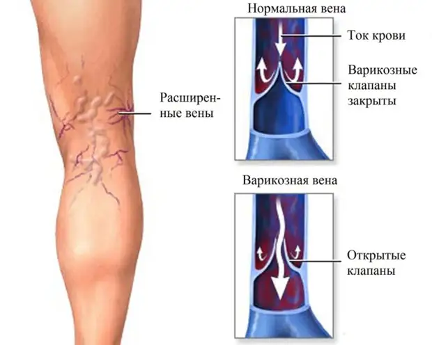 Варикоз на ногах — диагностика, лечение и профилактика