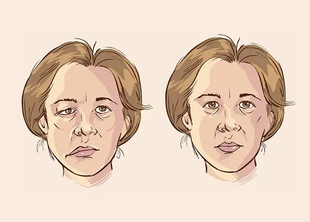 Как лечить неврит народными средствами