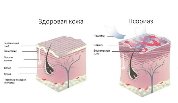 Натуральный рецепт для лечения псориаза