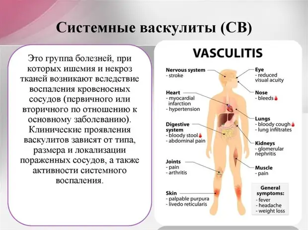 Что нужно знать о воспалении сосудов