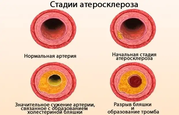 Что нужно знать об атеросклерозе сосудов головного мозга