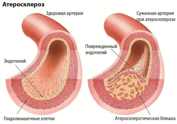 Симптомы атеросклероза сосудов ног