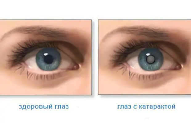 Причины, симптомы и профилактика катаракты, глазные капли