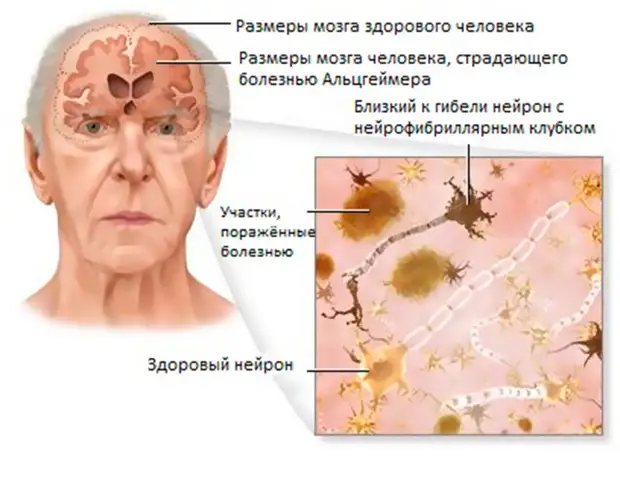 Как уберечь себя от болезни Альцгеймера