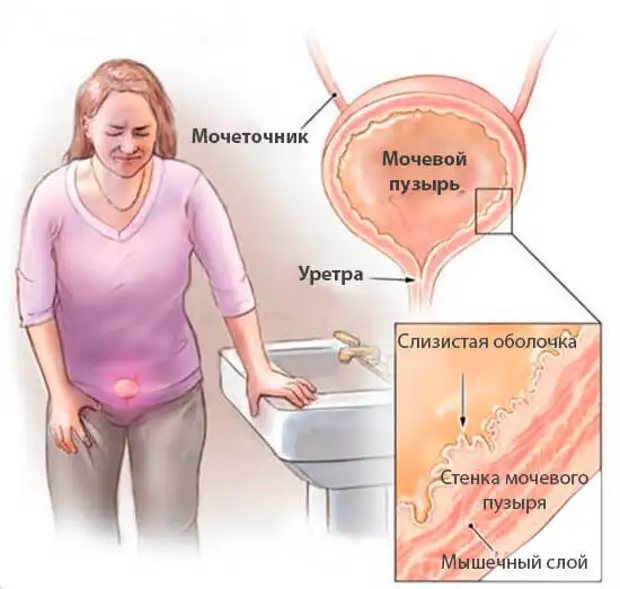 Как вылечить цистит за 1 день