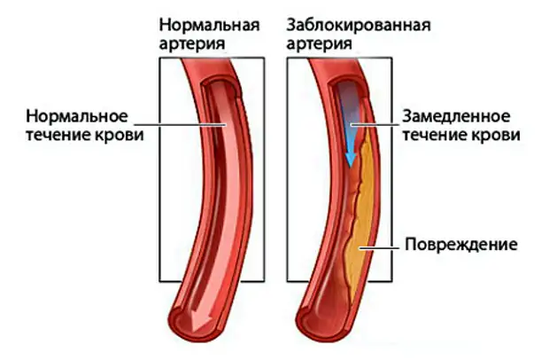 Нормальный уровень холестерина в крови