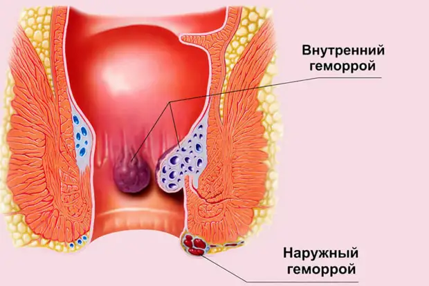 Советы для облегчения симптомов геморроя