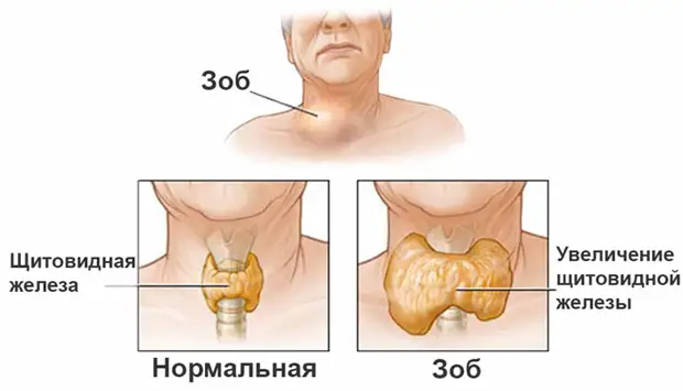 Зоб щитовидной железы симптомы и лечение