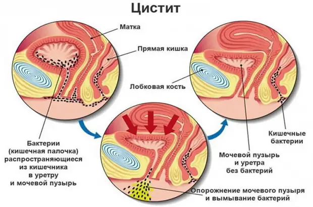 Как вылечить цистит за 1 день