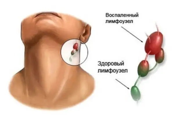 Когда следует беспокоиться о лимфатической системе