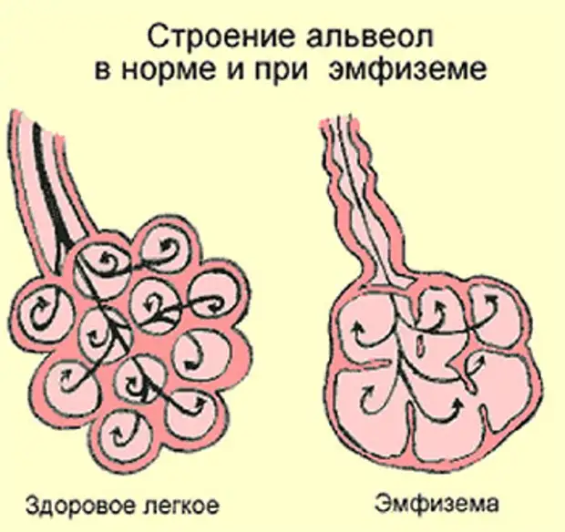 Эмфизема легких