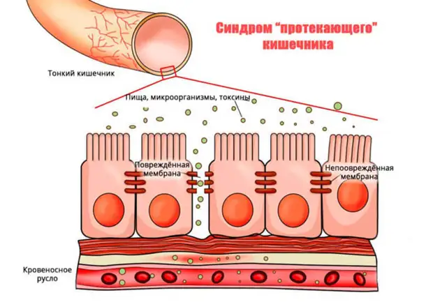 Симптомы синдрома дырявого кишечника