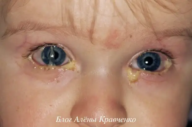 Гноятся глаза