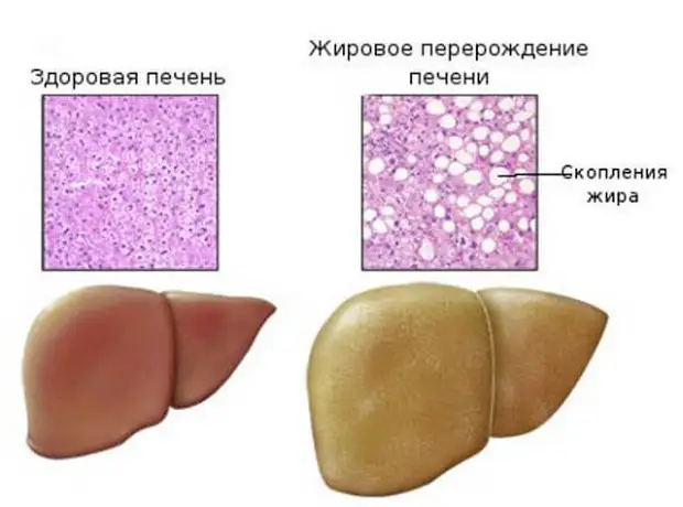Что такое лептинорезистентность и жировая болезнь печени