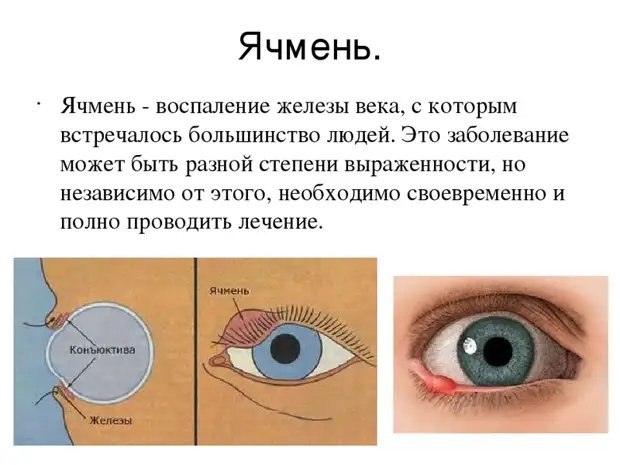 Безопасные способы борьбы с ячменем