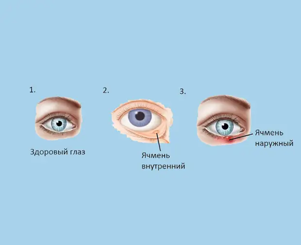 Безопасные способы борьбы с ячменем