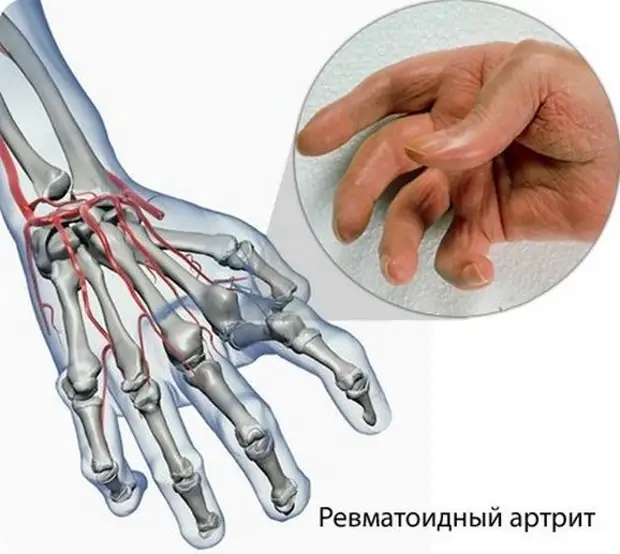 Первые симптомы ревматоидного артрита пальцев рук