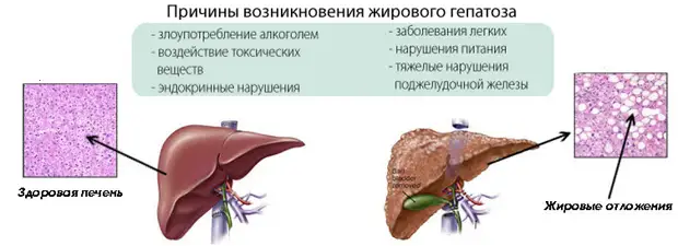 Чем опасен висцеральный жир