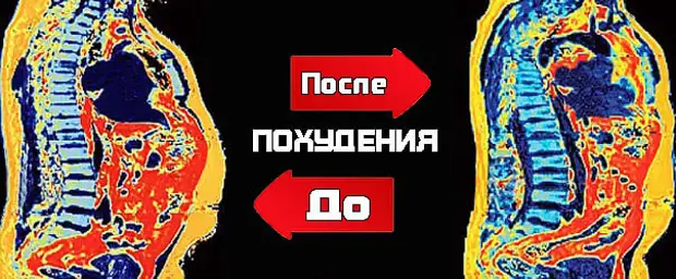 Чем опасен висцеральный жир