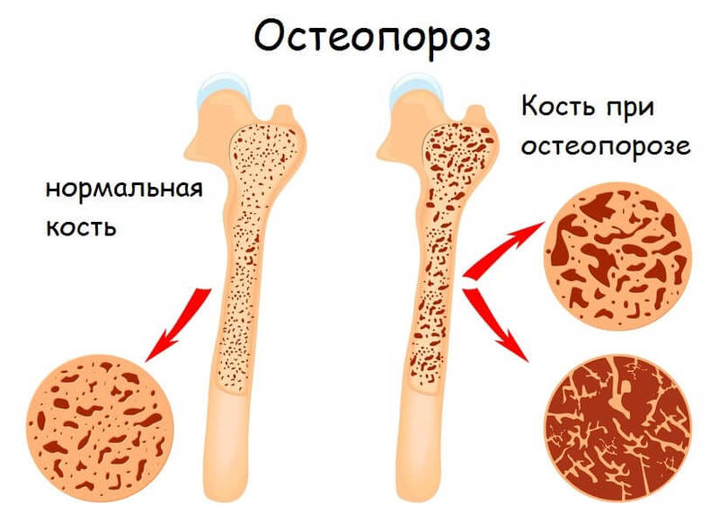 Селен поможет предотвратить остеопороз и снизить риск серьезных заболеваний Селен поможет предотвратить остеопороз и снизить риск серьезных заболеваний